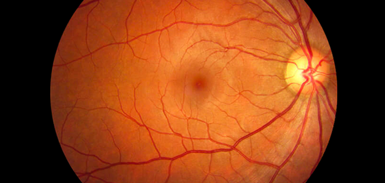 Retinal photography - images of retina for health of eyes