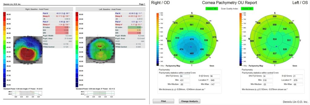 Keratoconus Topography and Pachymetry Example AB