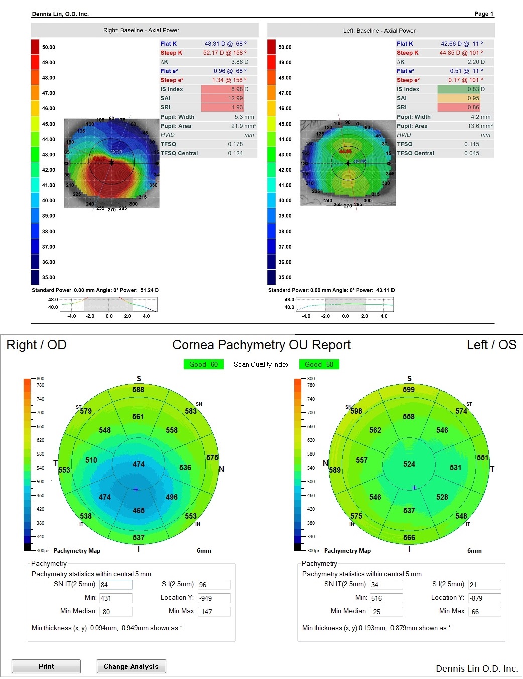 Click To View Keratoconus Topography and Pachemetry Examples