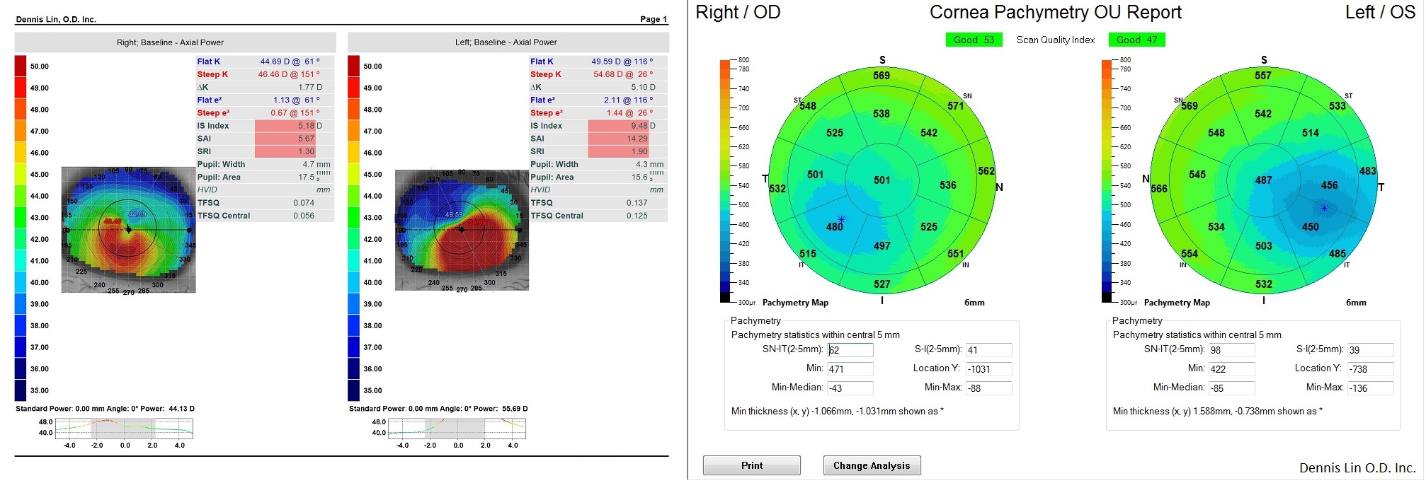 Keratoconus - Topography and Pachymetry Example BA