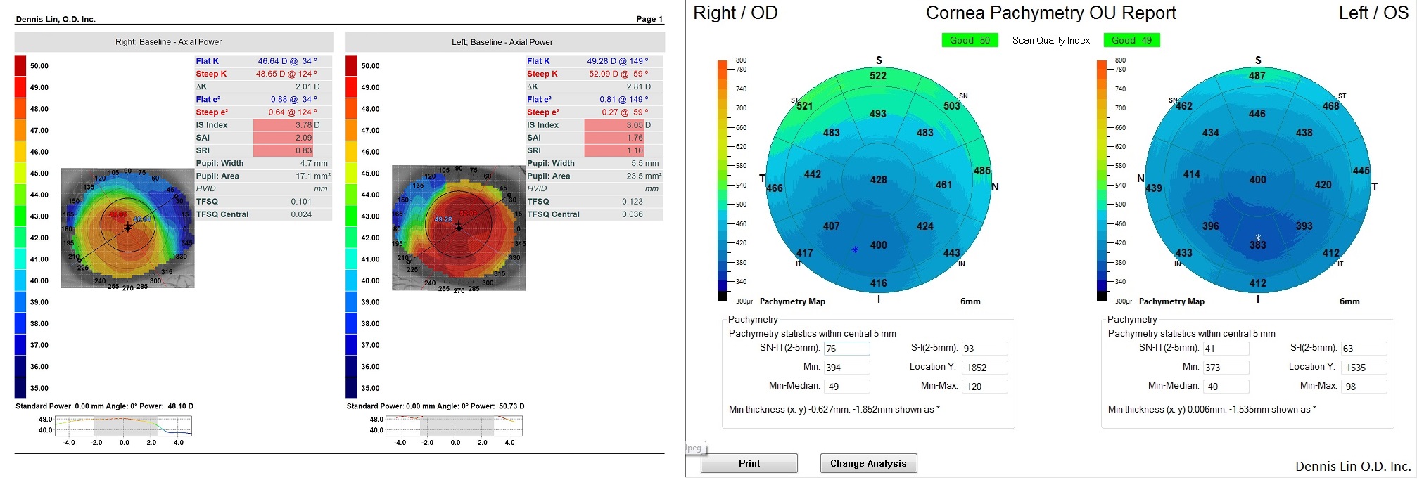 Keratoconus Topography and Pachymetry Example DN