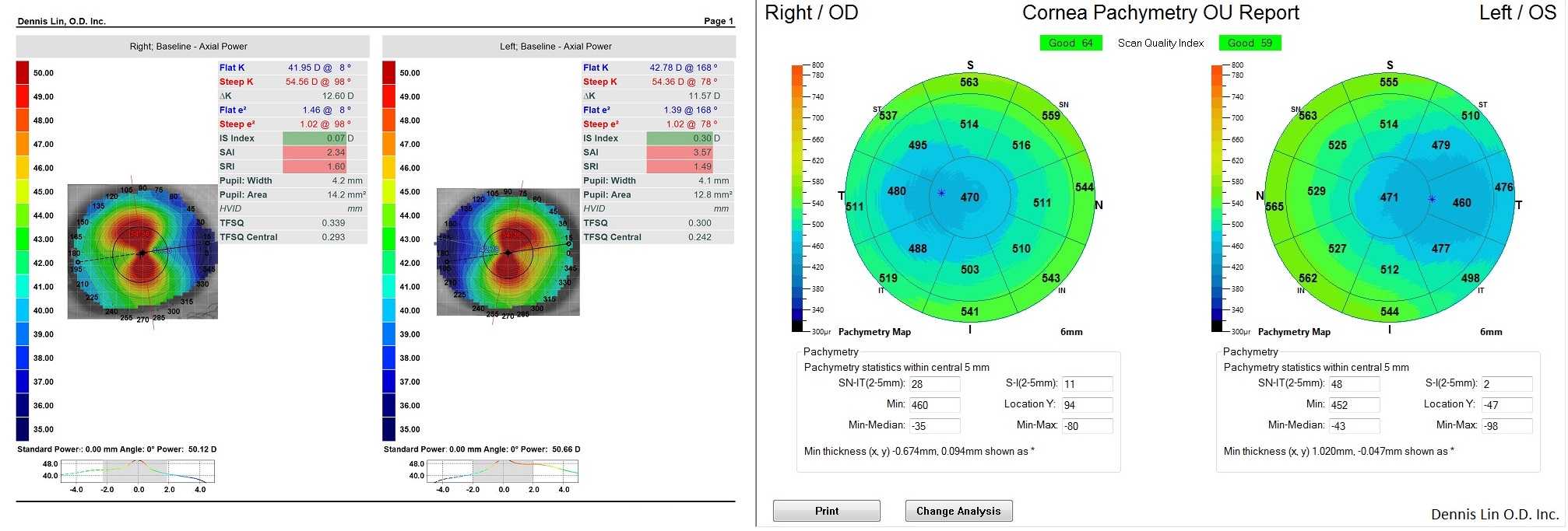 Keratoconus Topography and Pachymetry Example IL