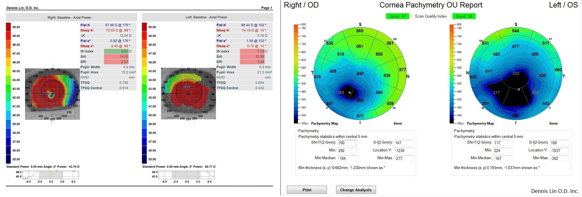 Keratoconus Topography and Pachymetry Example CE