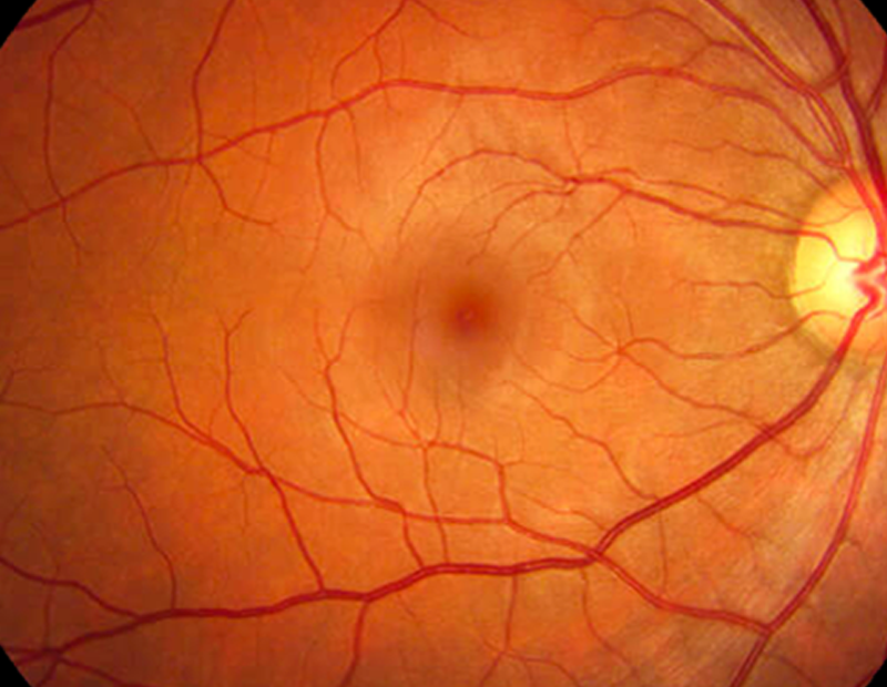 Retinal photography - images of retina for health of eyes