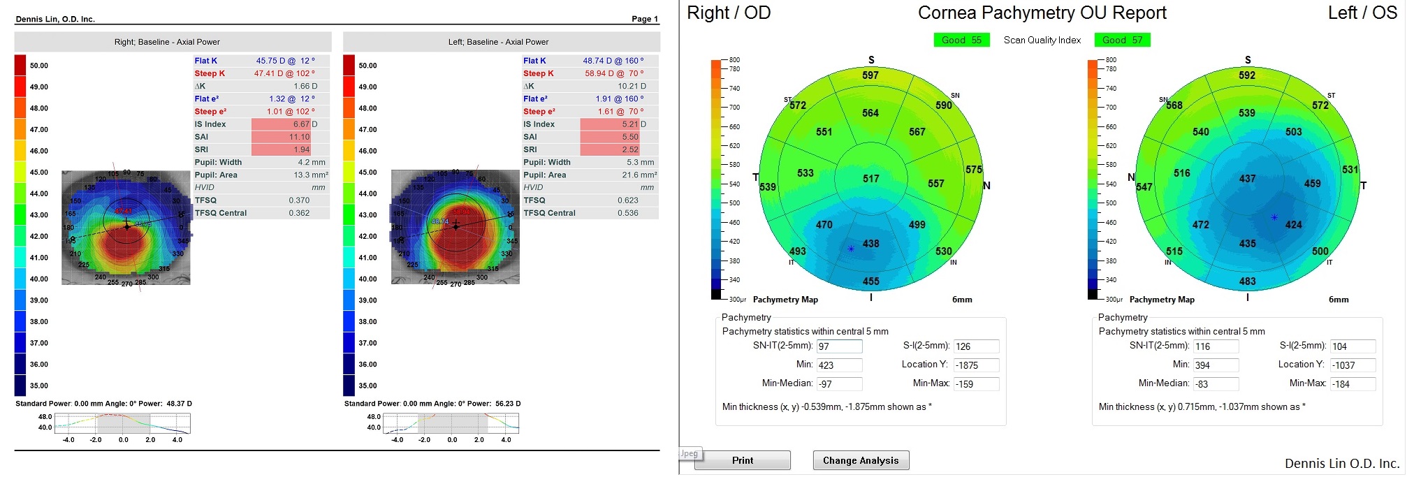 Keratoconus Topography and Pachymetry Example CL