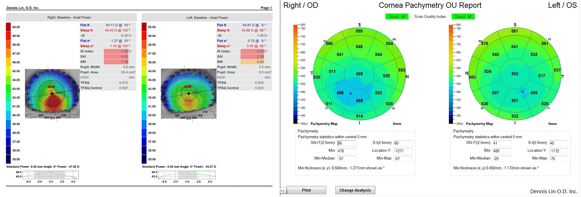 Keratoconus Topography and Pachymetry Example JB