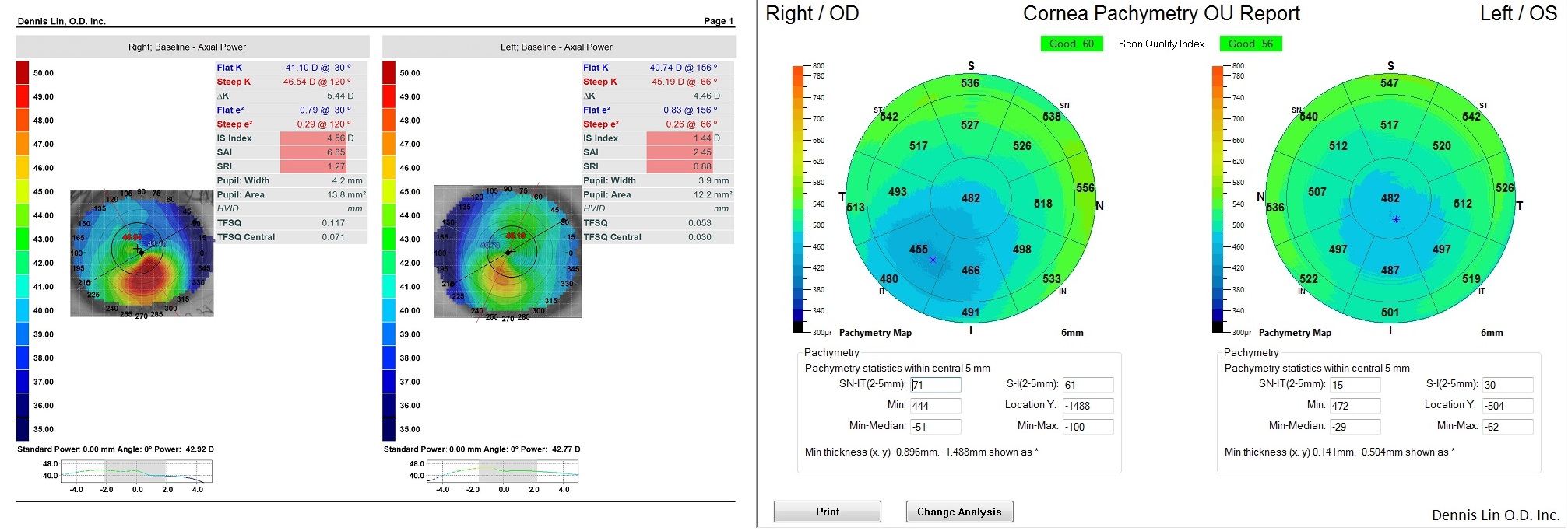 Keratoconus Topography and Pachymetry Example LB