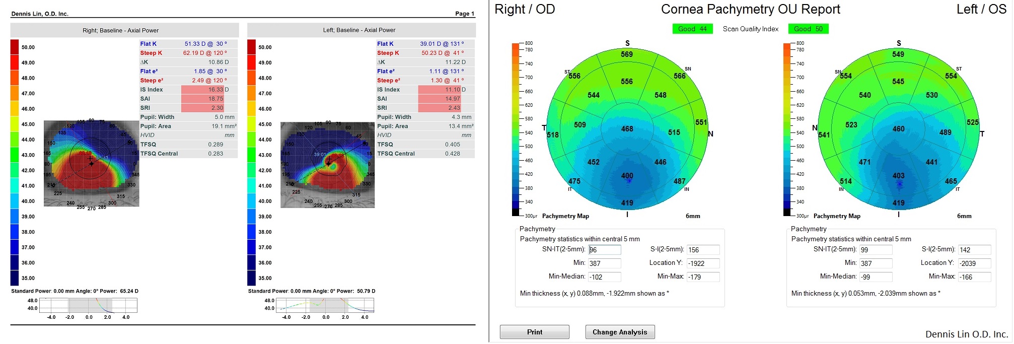 Keratoconus Topography and Pachymetry Example MM