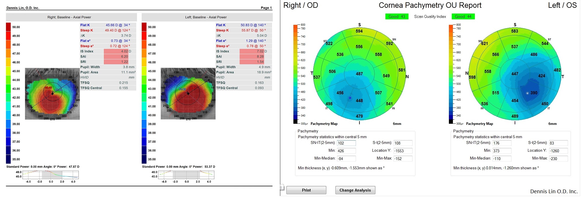 Keratoconus Topography and Pachymetry Example SM
